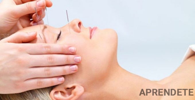 acupuntura-ansiedad-1